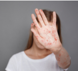 האם מחלת החצבת במגמת נסיגה או שיש מקום לדאגה?-תמונה